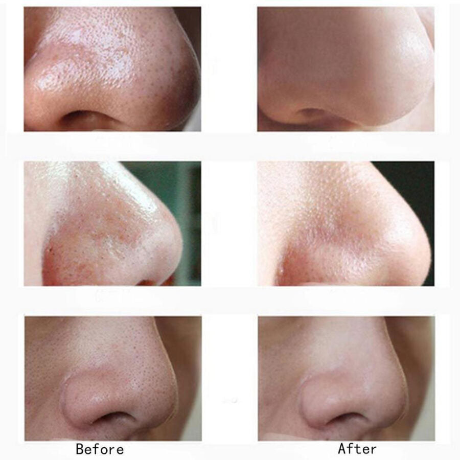 Blackhead Remover Face Acne Black Dot Pimple Electric Blackhead Vacuum Cleaner Pore Skin Care Tools Machine 4 Replacement Head
